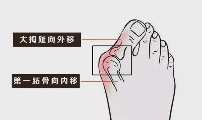 最开始出现的症状是第一跖趾关节部位拇囊容易发炎,到后期还有可能